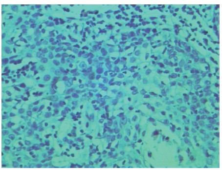 喉癌组织NF-κBp65阴性表达对照(×400)